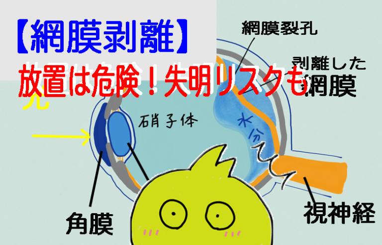 網膜剥離
