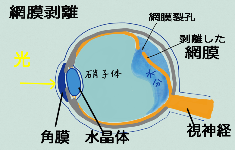 網膜剥離